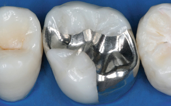 Restorative Dentistry in Vizag