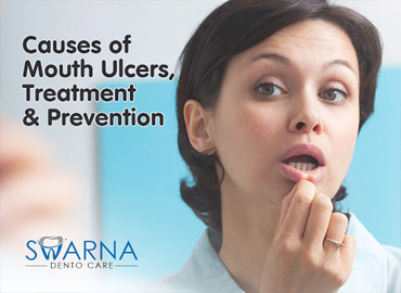 Causes of Mouth Ulcers