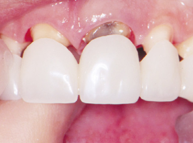 Best Dental Crown and Bridges Treatment Clinic in Vizag
