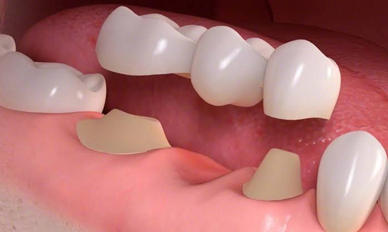 Best Dental Crown and Bridges Treatment Clinic in Vizag