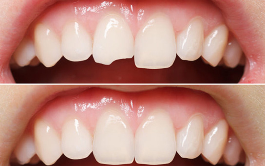 Damaged Teeth Replacement in Vizag