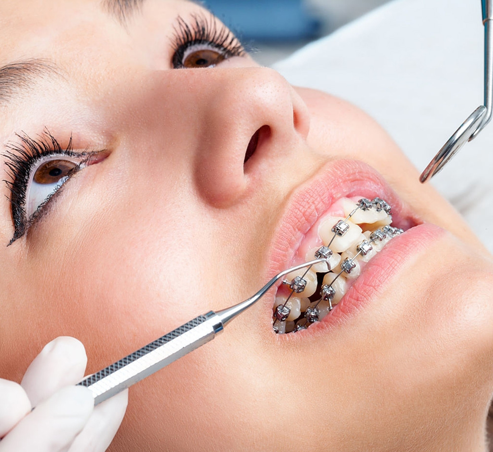 Best Orthodontic Treatment in Visakhapatnam