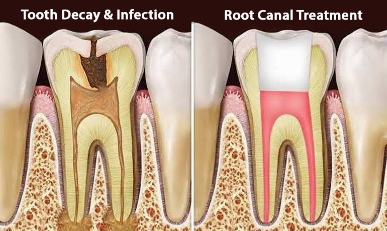 Root Canal Treatment in Vizag