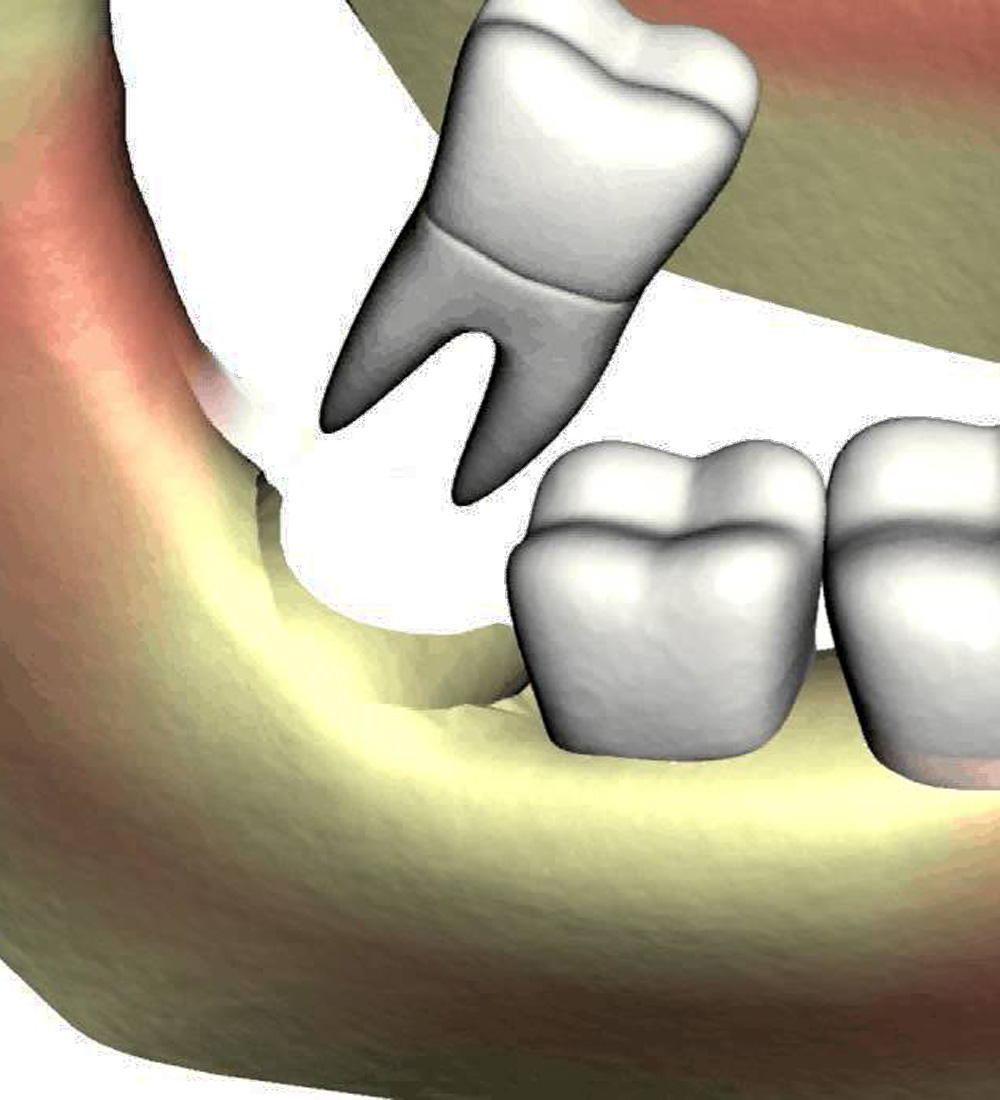 Wisdom Tooth Extraction in Visakhapatnam