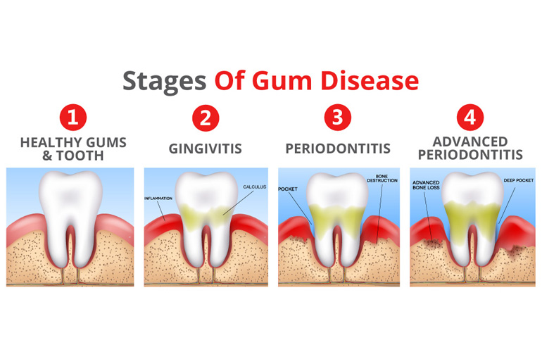 Gum Diease Treatment in Vizag