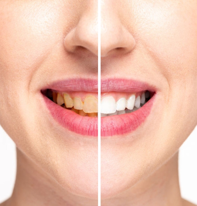 Teeth Whitening Servicce in Vizag