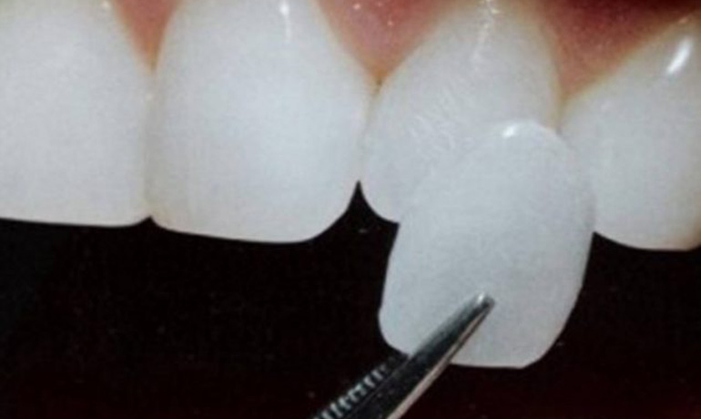 Dental Veneers in Visakhapatnam Dental Veneers in Visakhapatnam
