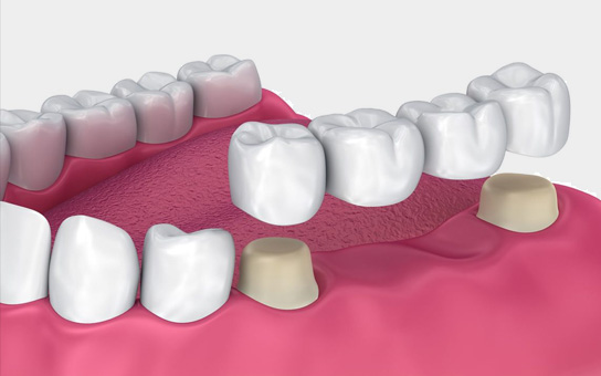 Dentures services in Visakhapatnam Dentures services in Visakhapatnam