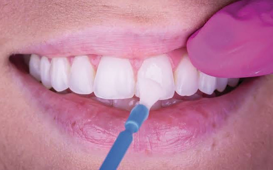 Fluoride Treatment in Visakahapatnam Fluoride Treatment in Visakahapatnam