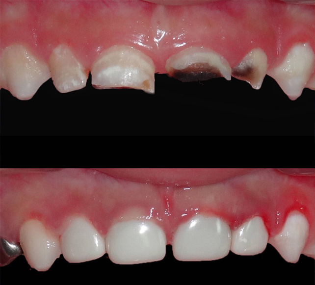 Milk Teeth Removal in Vizag kids dentistry in Visakhapatnam