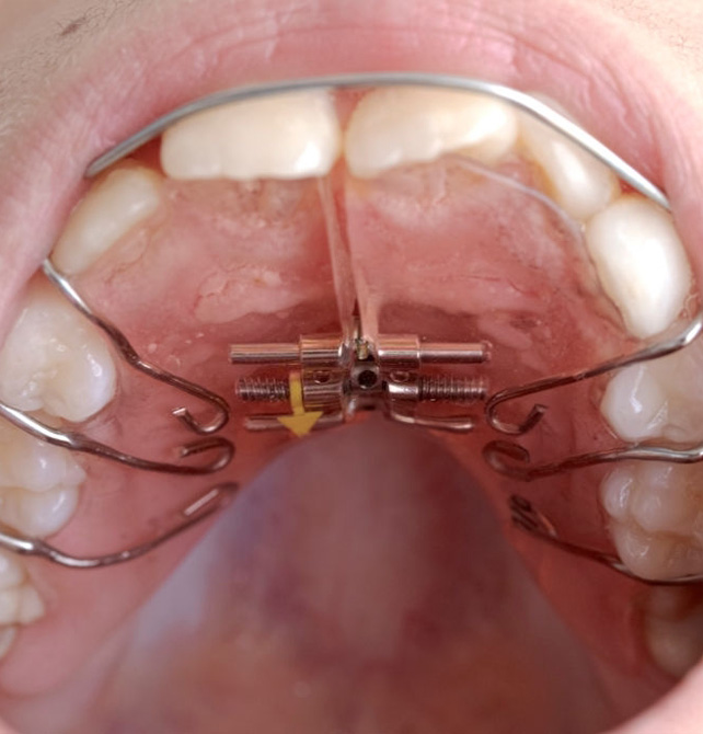 Kids Dentist in Visakhapatnam Kids Dentist in Visakhapatnam