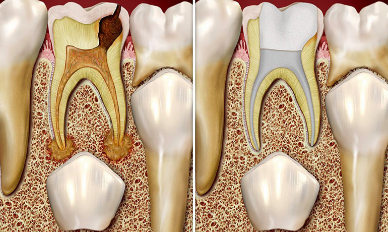 Root Canal Treatment for Kids in Vizag Root Canal Treatment for Kids in Vizag
