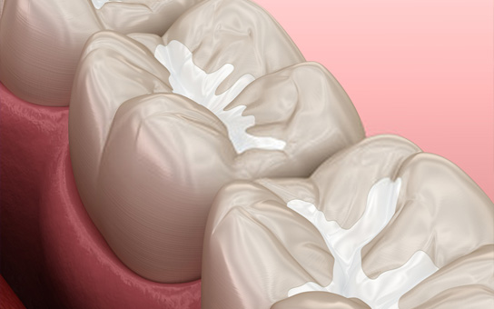 Preventive Dentistry in Visakhapatnam Preventive Dentistry in Visakhapatnam