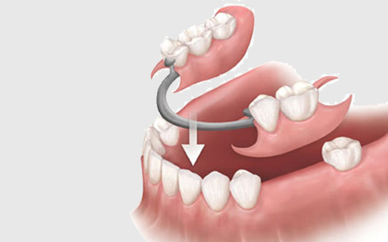 Missing Teeth Replacement in Visakhapatnam Missing Teeth Replacement in Visakhapatnam