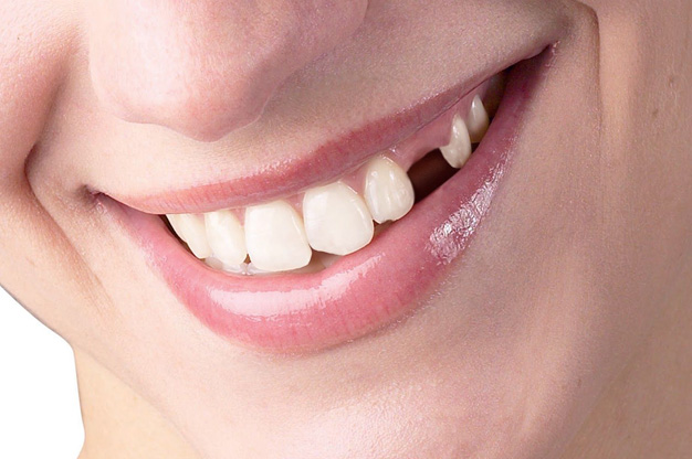 Missing Teeth Replacement in Vizag Missing Teeth Replacement in Vizag