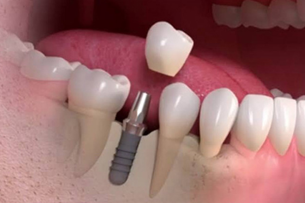 Dental Implant Clinic in Visakhapatnam Dental Implant Clinic in Visakhapatnam