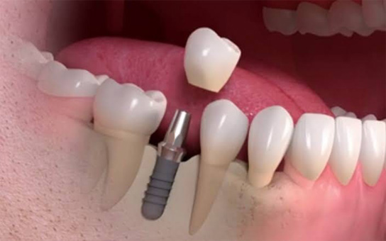 Dental Implant Clinic in Visakhapatnam Dental Implant Clinic in Visakhapatnam
