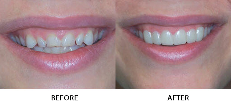 Smile Makeover in Visakhapatnam Smile Makeover in Visakhapatnam