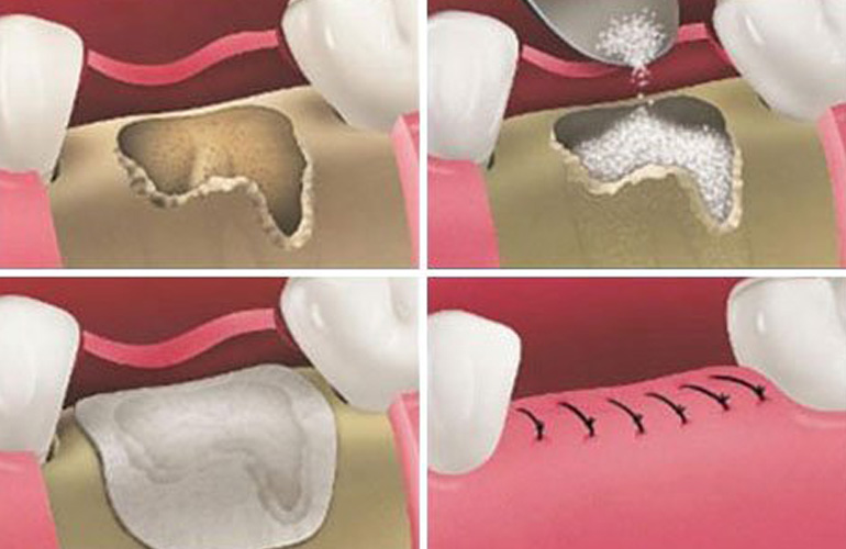 Bone Graft in Vizag Bone Graft in Vizag