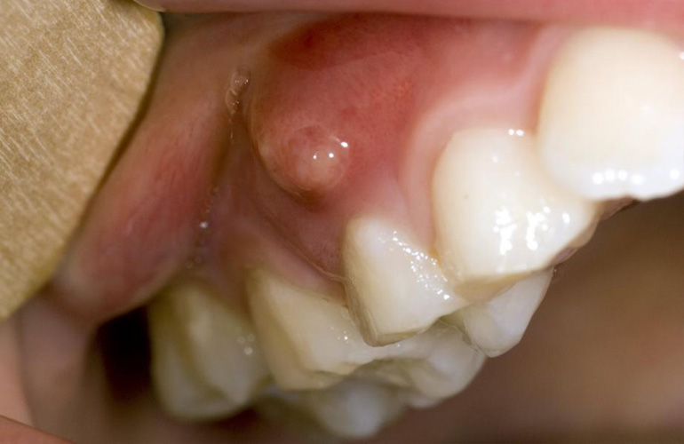 Broken Teeth Treatment in Vizag Broken Teeth Treatment in Vizag