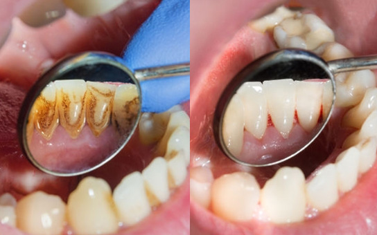 Tooth Cleaning Service in Visakhapatnam Tooth Cleaning Service in Visakhapatnam