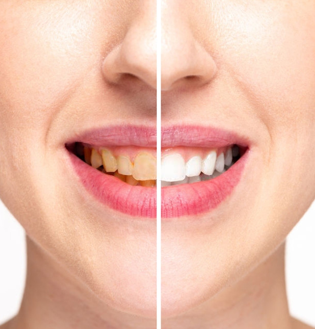 Teeth Whitening Service in Vizag Teeth Whitening Service in Vizag