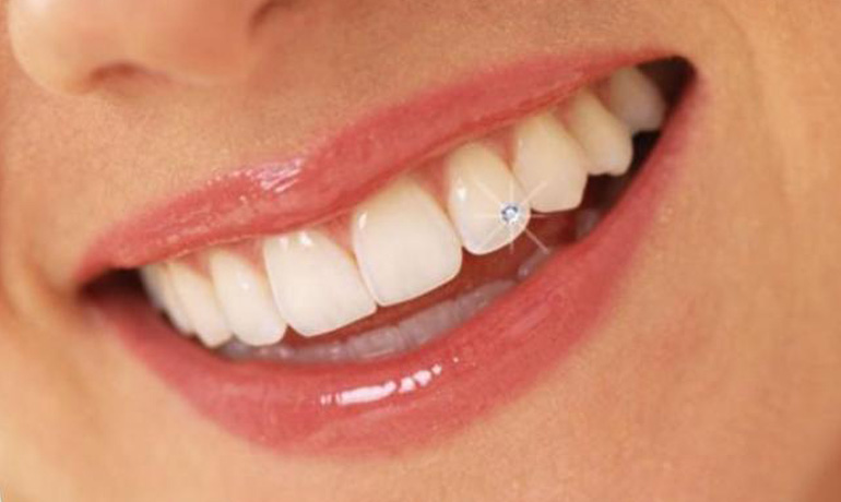 Tooth Jewel in Visakhapatnam Tooth Jewel in Visakhapatnam