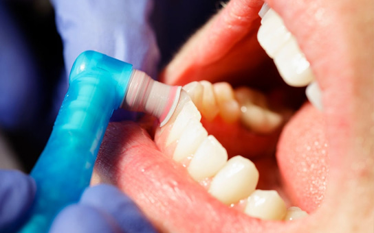 Tooth Polishing Service in Vizag Tooth Polishing Service in Vizag